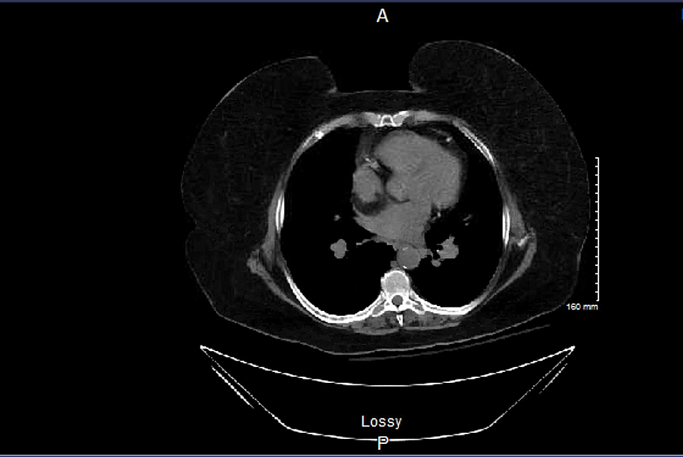 CT-abdomen-showing-an-18-mm-cyst-upper-pole-right-kidney-with-a-parapelvic-cyst-measuring-18-mm-x-18-mm.