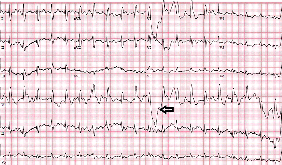 EKG-showing-intraventricular-block.