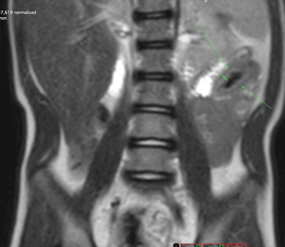 Crohn's Disease Developing After Hirschsprung's Disease in a Child With Down Syndrome