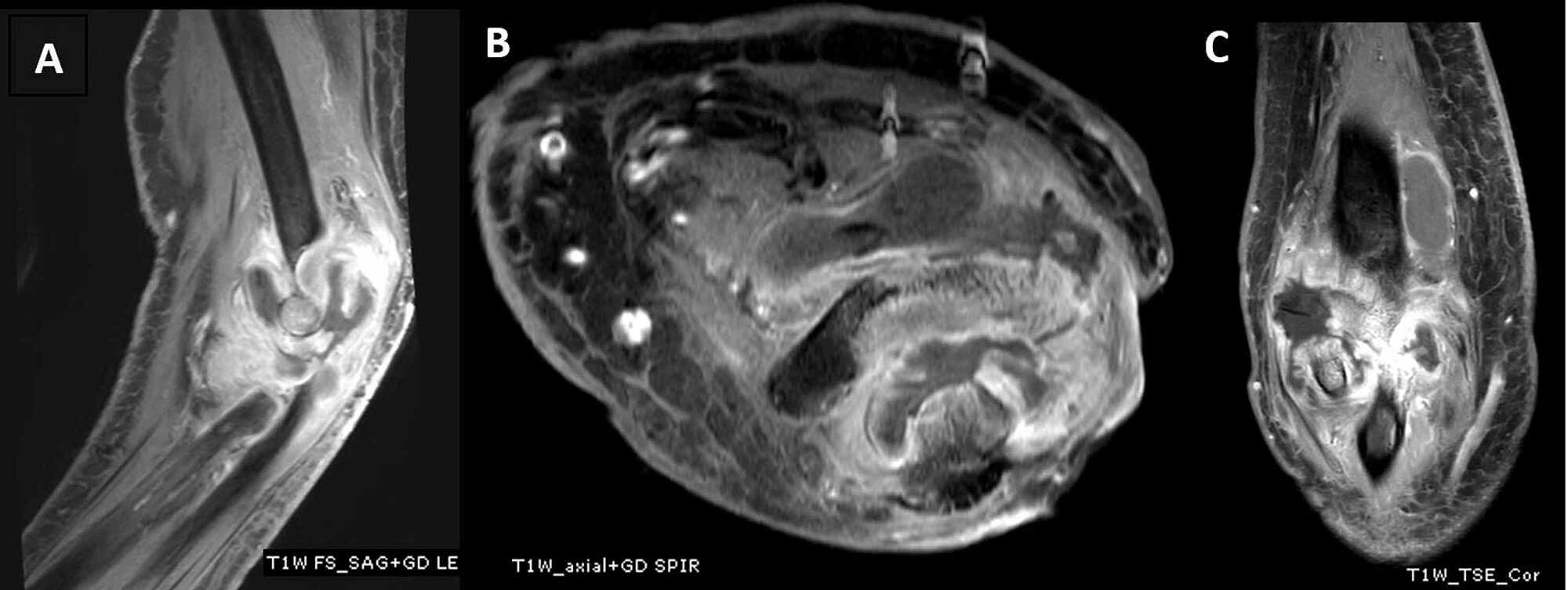 Cureus Tuberculosis Septic Arthritis of the Elbow A Case Report and Literature Review