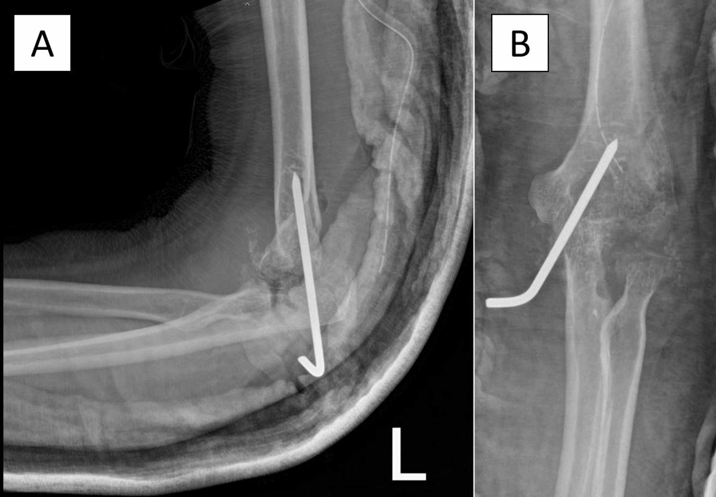Cureus Tuberculosis Septic Arthritis of the Elbow A Case Report and