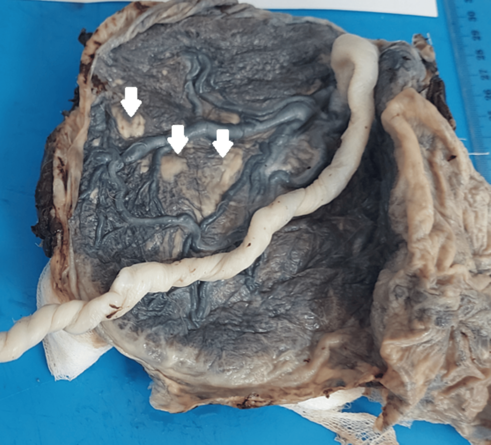 Placentas From COVID-19-Positive Mothers: A Morphological Study of