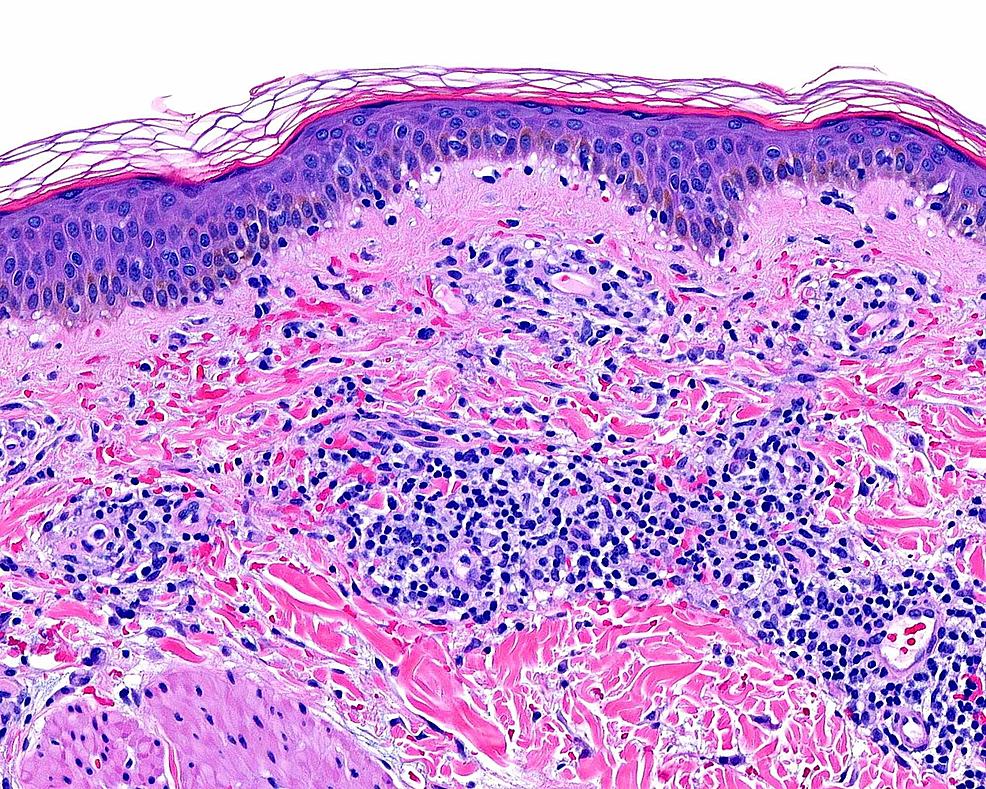 Cureus Rutoside and Ascorbic Acid in the Treatment of Schamberg