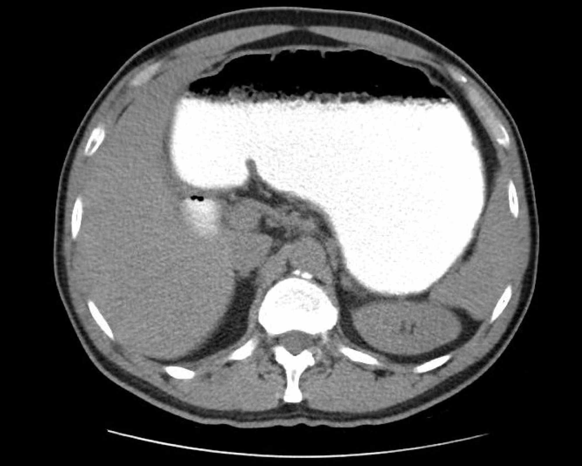 Cureus Abdominal Cocoon Syndrome An Extremely Rare Cause Of Small Bowel Obstruction