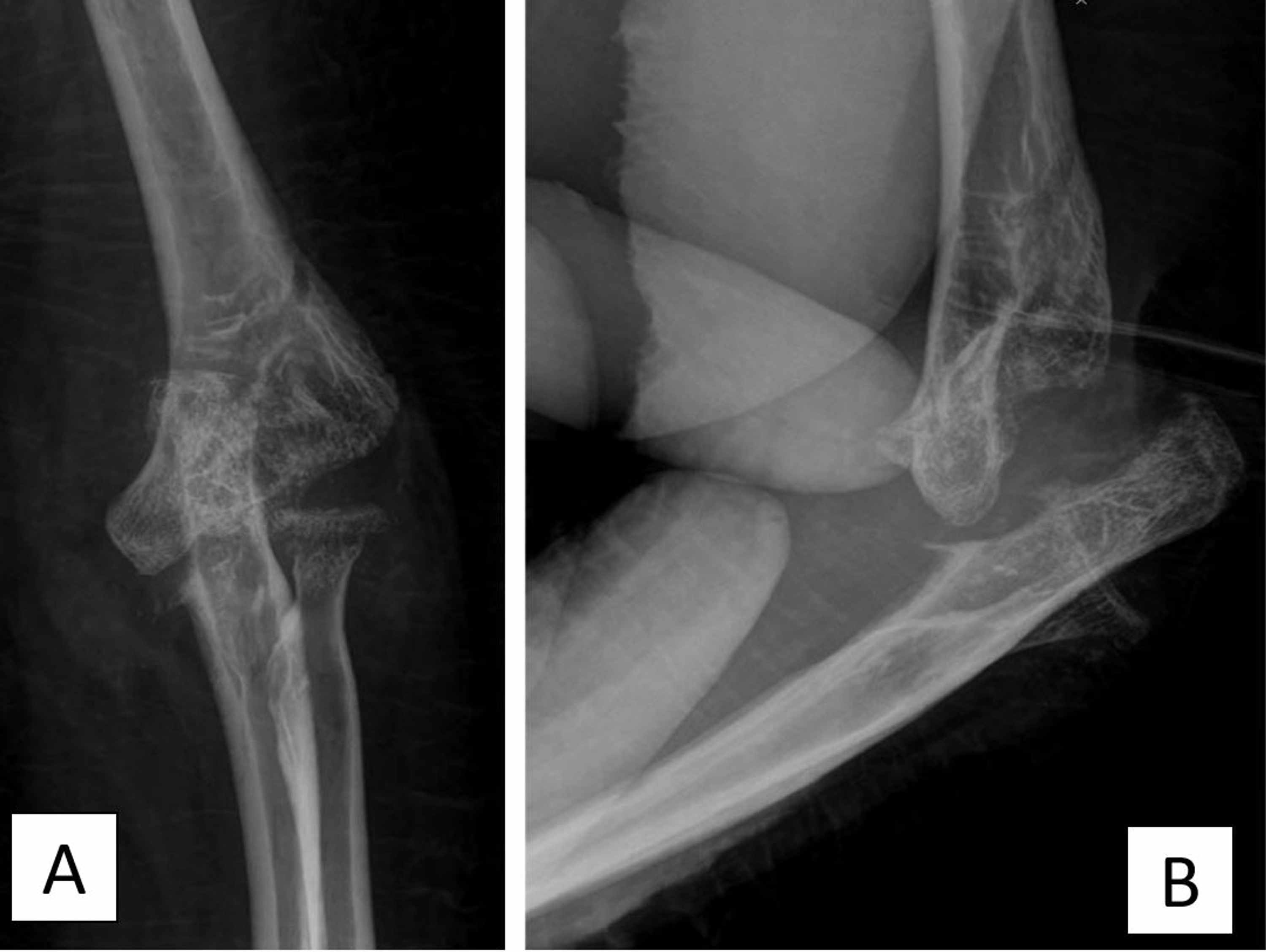 Cureus Tuberculosis Septic Arthritis of the Elbow A Case Report and