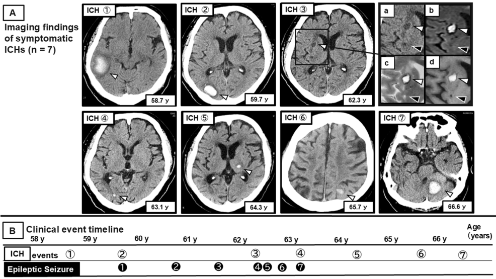 Dynamic Spatiotemporal Shifts of Cerebral Microbleeds and Dynamic Spatiotemporal Shifts of Cerebral Microbleeds and