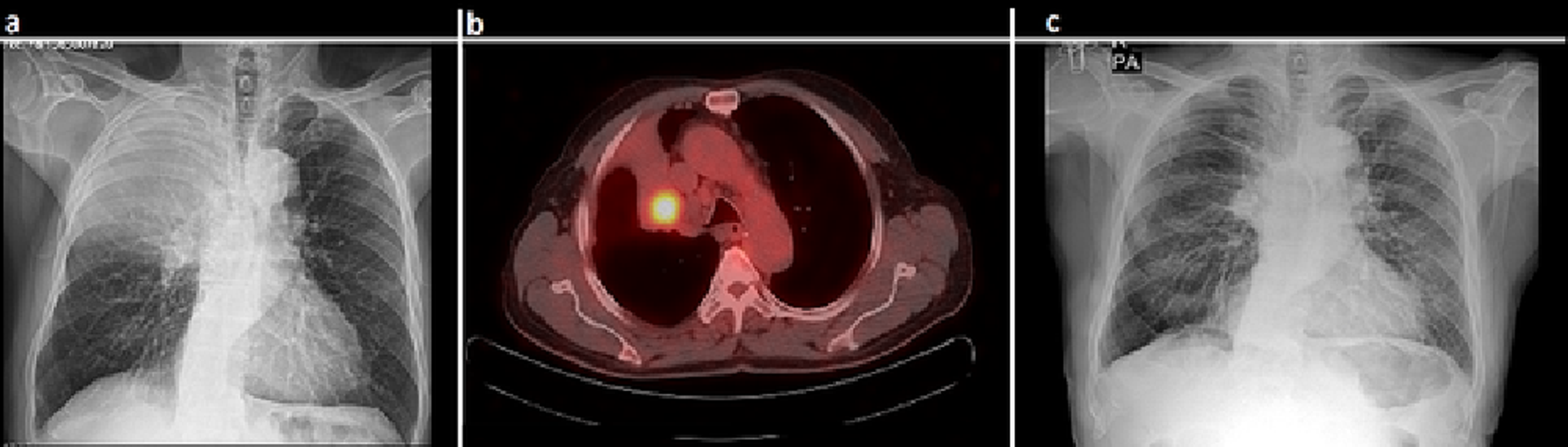 Cureus Videothoracoscopic Bronchial Sleeve Resection for NonSmall