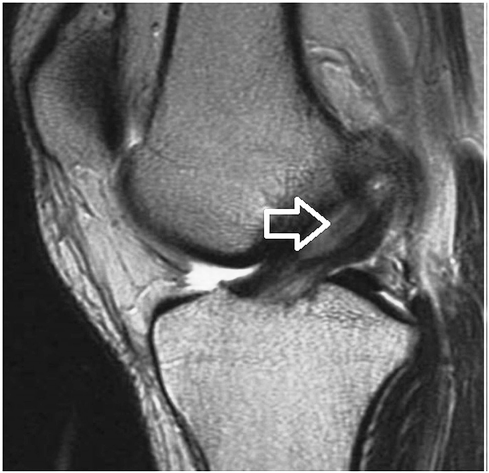 Cureus Anterior Cruciate Ligament Ganglion Cyst and Mucoid