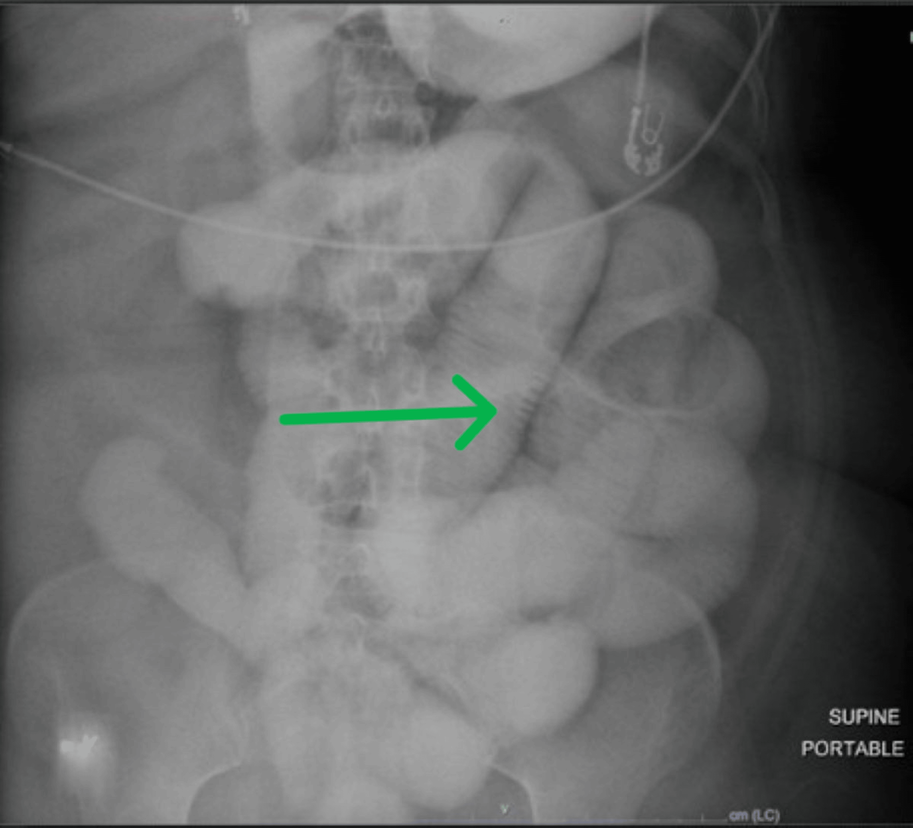 effects of taking semaglutide Semaglutide Before and After: Real Results effects of taking semaglutide Semaglutide Before and After: Real Results