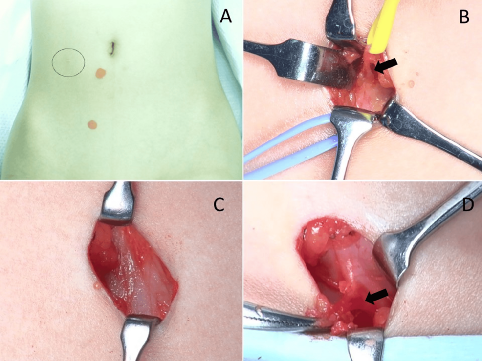 ACNES in Children: Fibrotic Entrapment & Traumatic Neuroma Mechanisms - News Directory 3