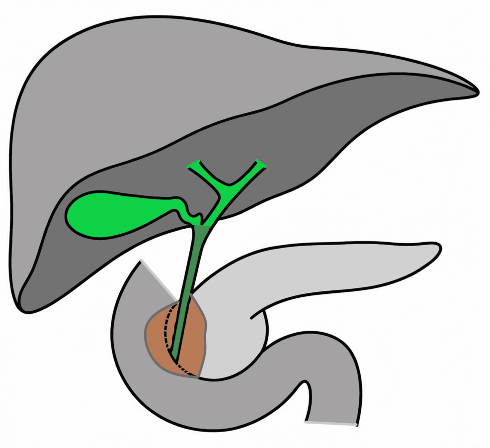 Surgery for Improved Outcomes: Resection Benefits