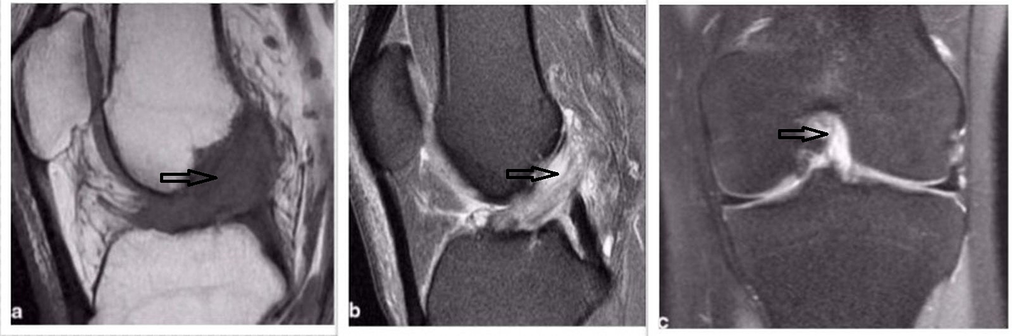 Cureus Anterior Cruciate Ligament Ganglion Cyst and Mucoid