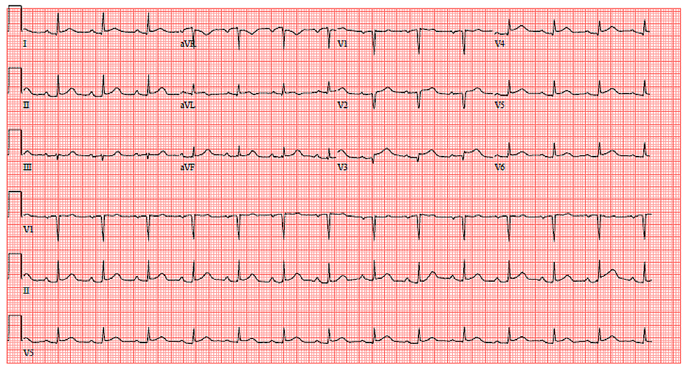 Cureus | Recurrent Stress-Induced Cardiomyopathy With Cardiogenic Shock ...