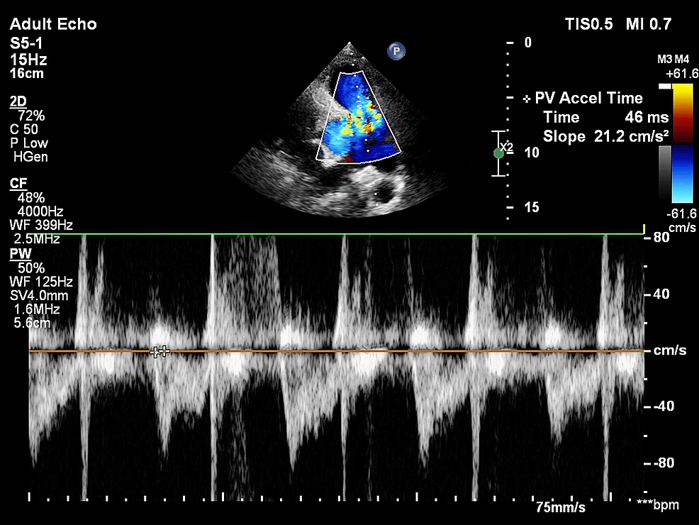 Analysis of the 60/60 Sign and Other Right Ventricular Parameters by 2D Transthoracic