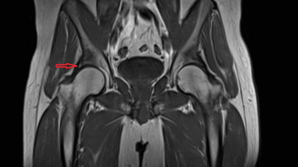 Osteomalacic Pelvis