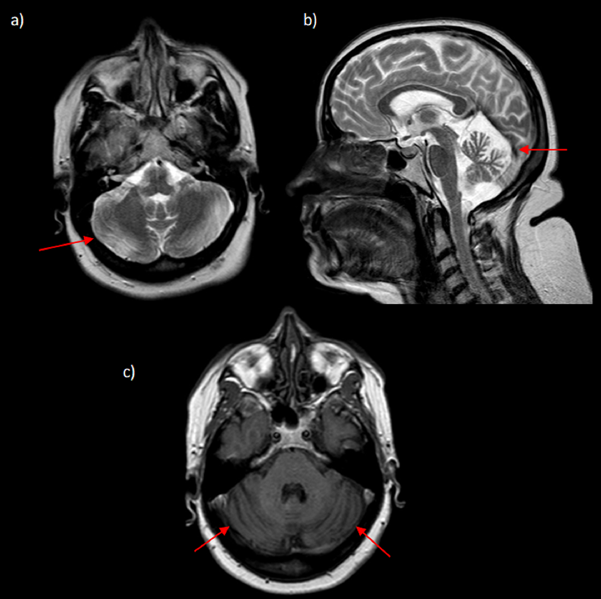 Cureus | A New Phenotype of Ataxia With Oculomotor Apraxia Type 4