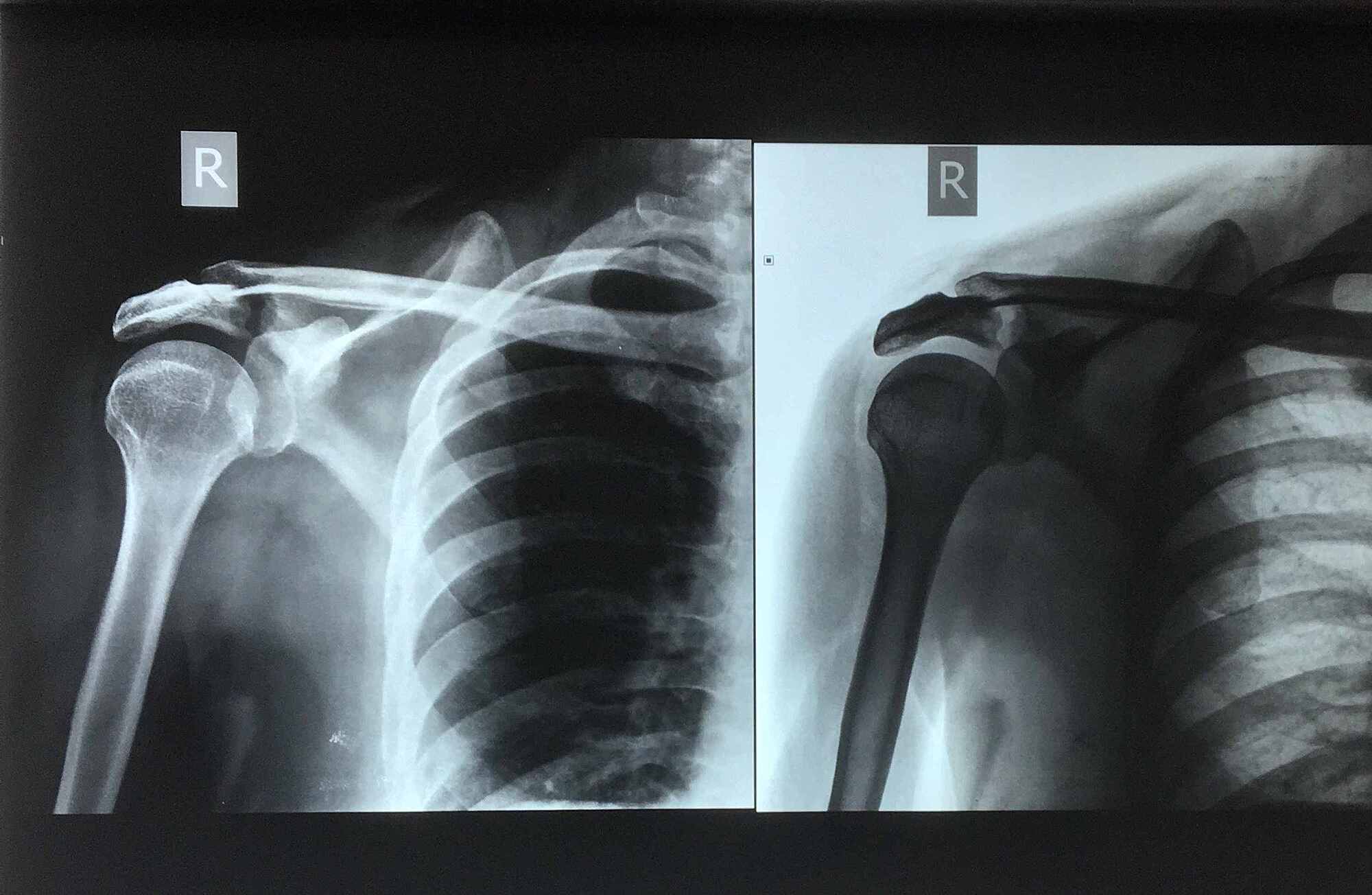 Acromion Types Radiology