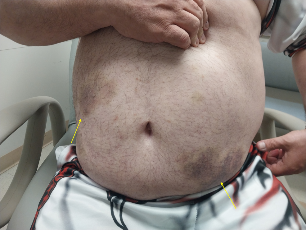 tirzepatide and antibiotics reddit A Rare Case of Tirzepatide-Associated Immune Thrombocytopenia