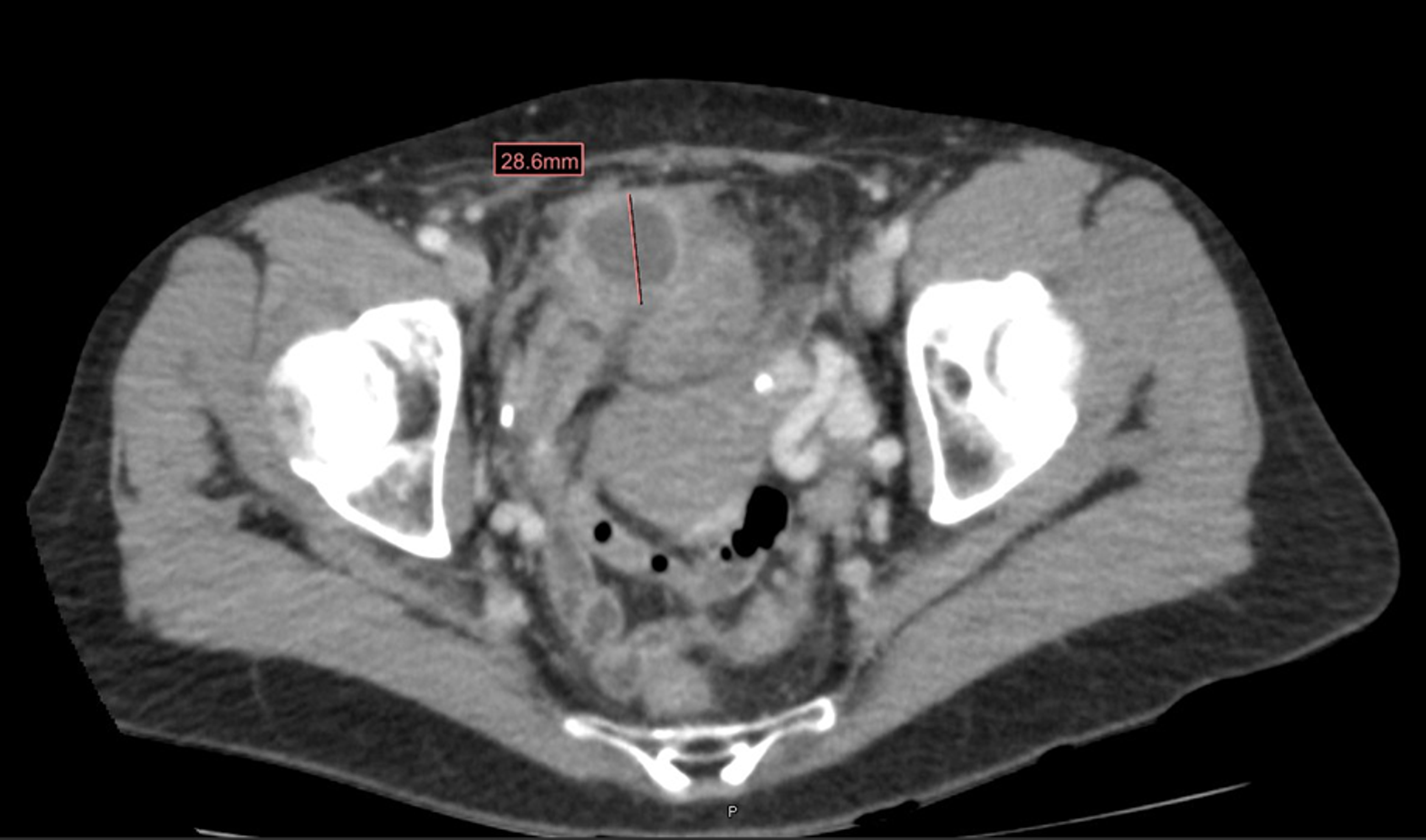 Cureus Appendiceal Adenocarcinoma Presenting As Perforated Appendicitis