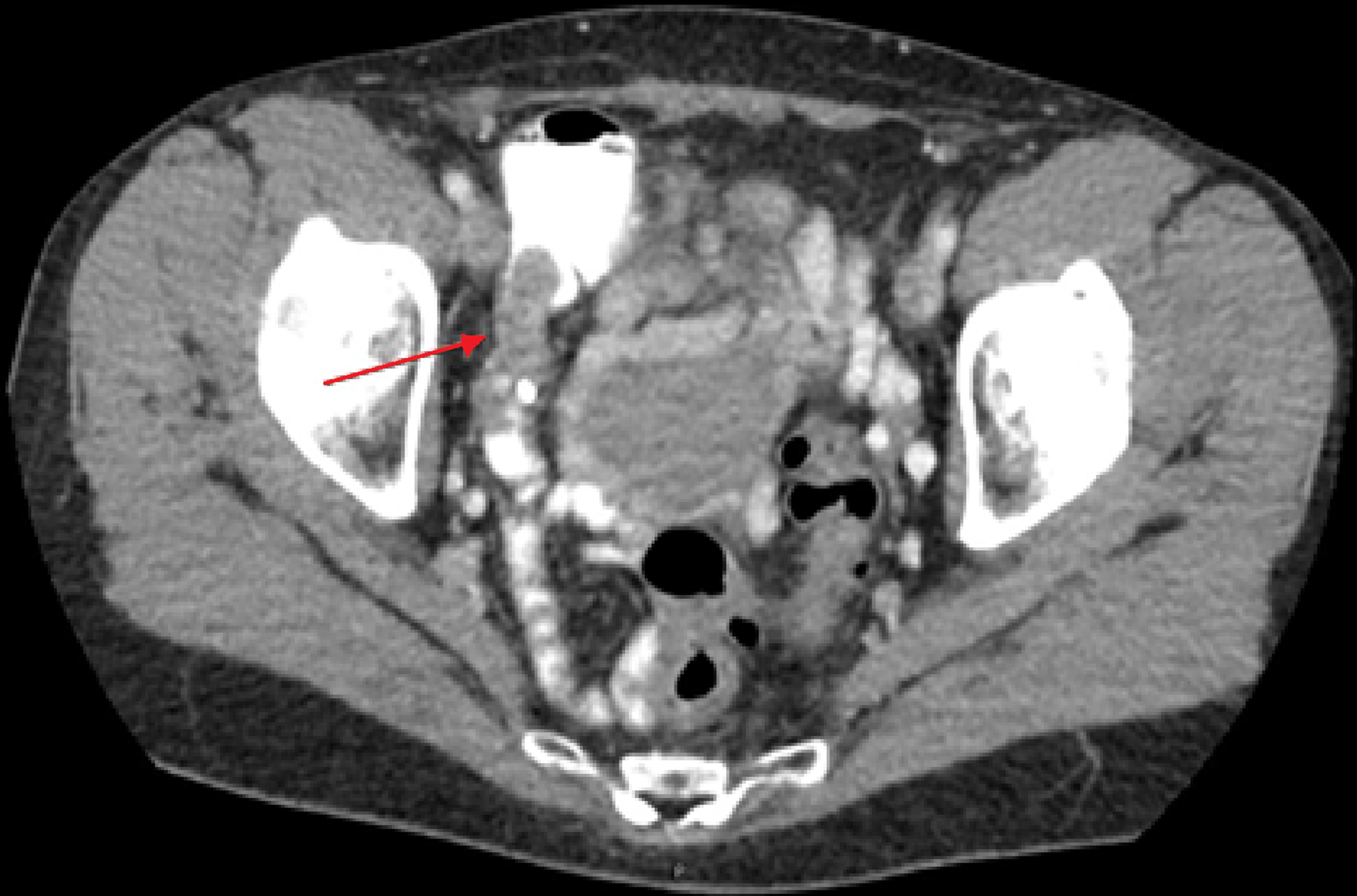 Cureus | Appendiceal Adenocarcinoma Presenting As Perforated Appendicitis