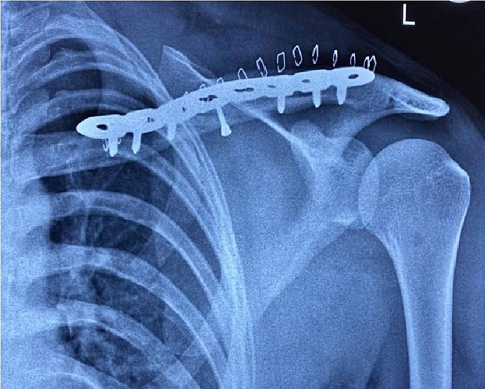 Figure 8 Clavicle Fracture