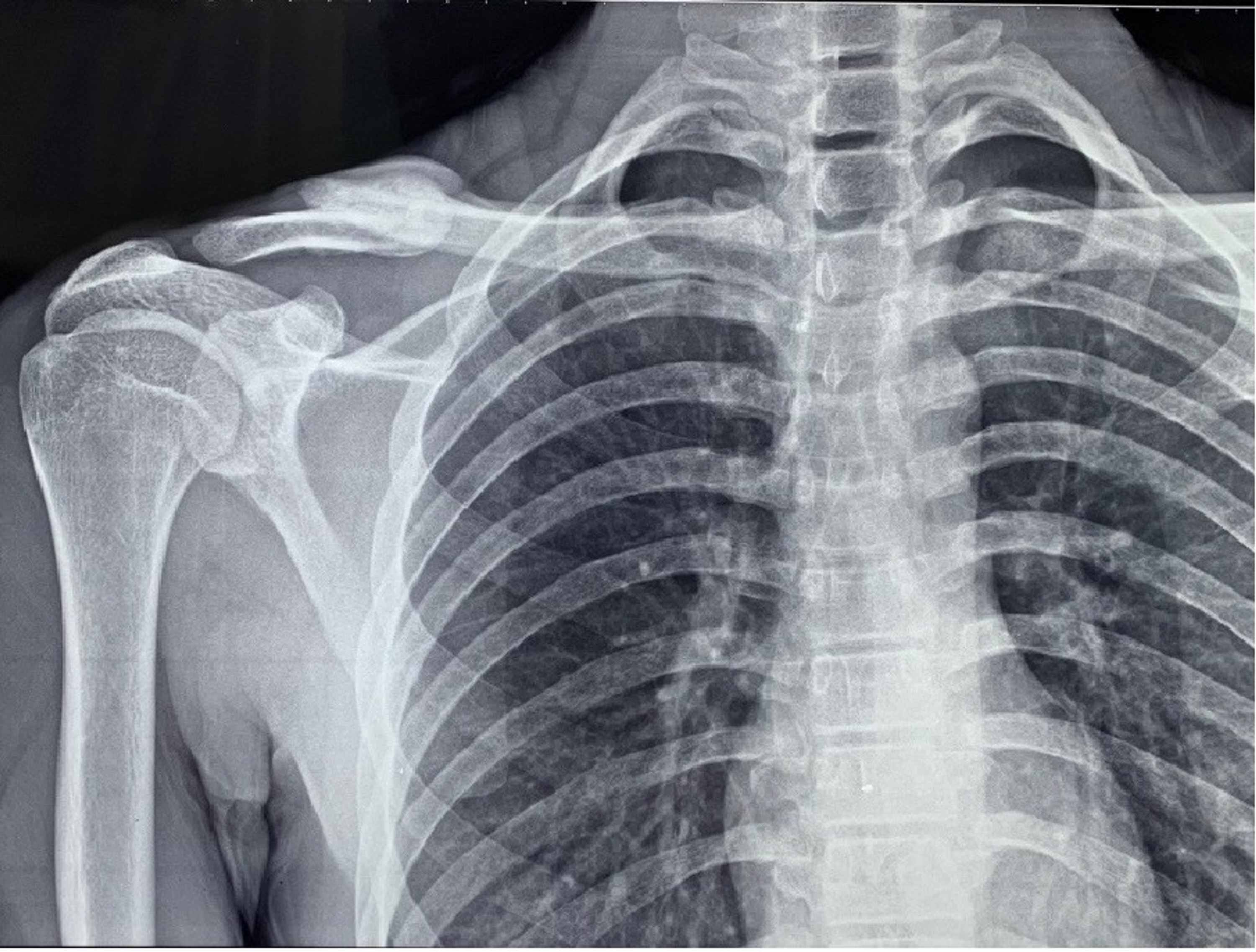 Cureus Plate Osteosynthesis Or Figure Of Eight Brace Which One Is Better In Midshaft Clavicle Fractures
