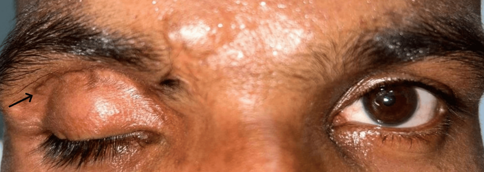 Outcome of Fascia Lata Frontalis Sling Suspension in a Challenging Case of Post-traumatic Aponeurotic Ptosis with an Upgaze Limitation: A Case Report