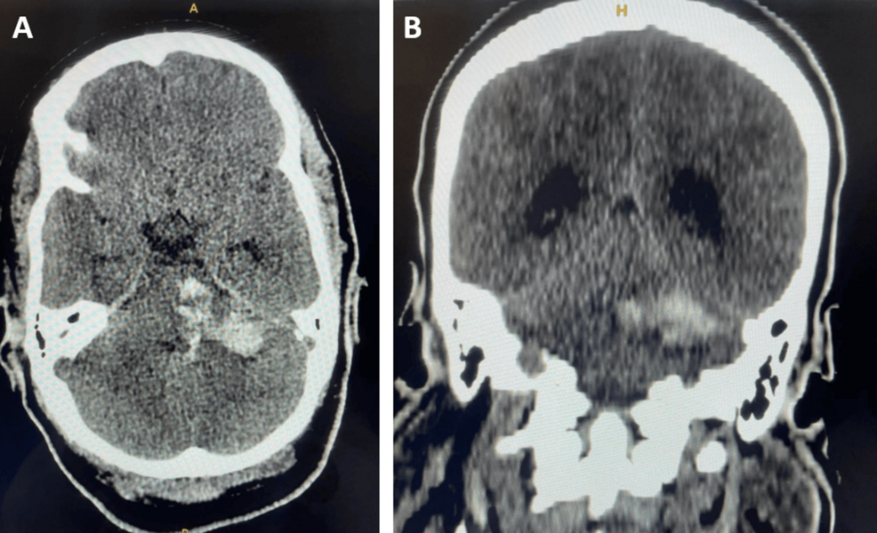 Brainstem Hemorrhage After Eclampsia & HELLP: A Case Report