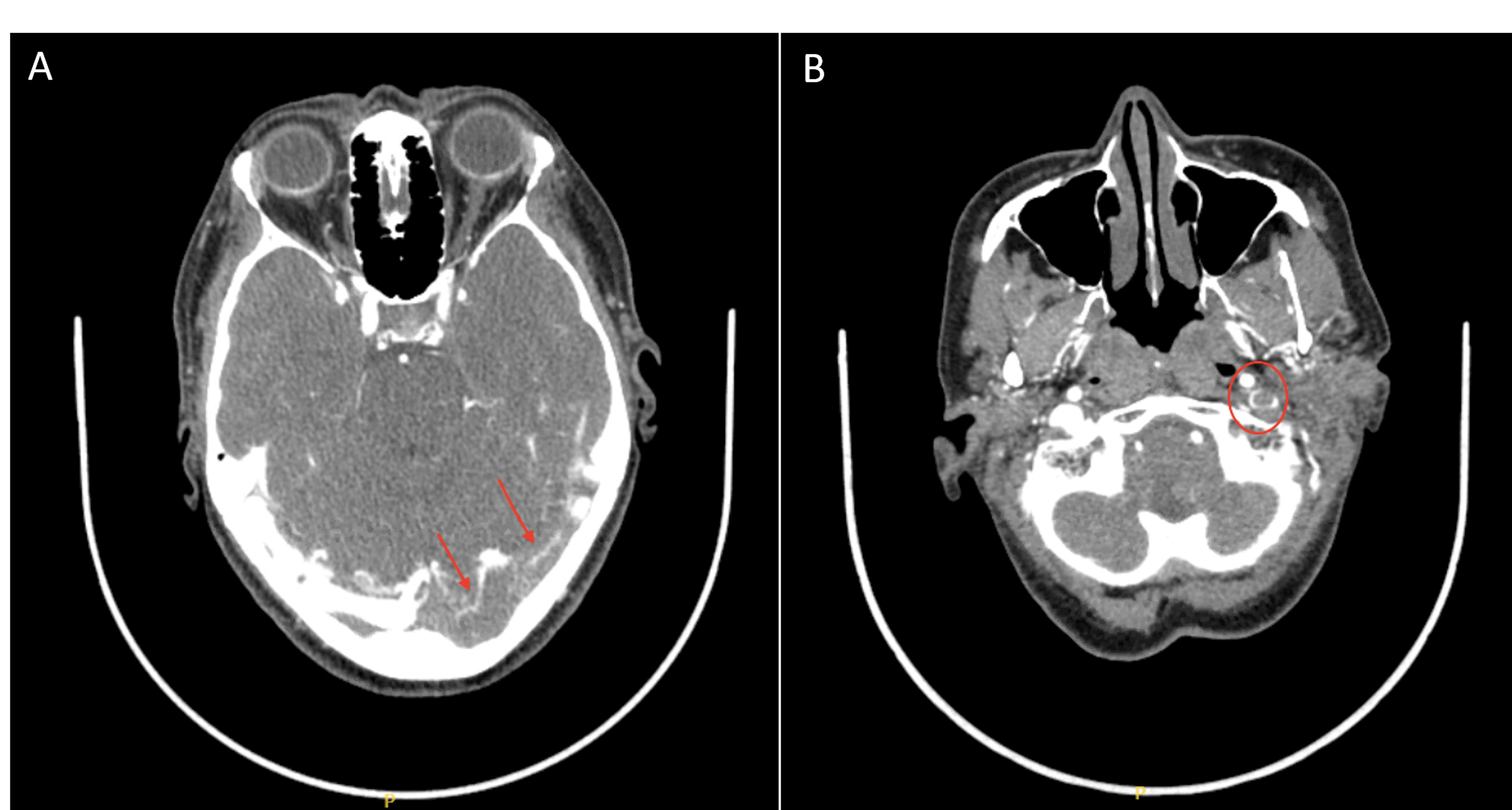 cureus-a-rare-thrombophilic-occurrence-dural-venous-sinus-thrombosis