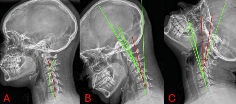 Radiographic Sagittal Alignment and Neurological Changes Following