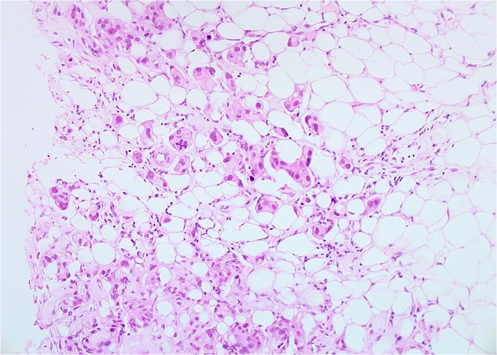 Cureus | Metastatic HER2+ Breast Cancer: A Potentially Curable Disease?