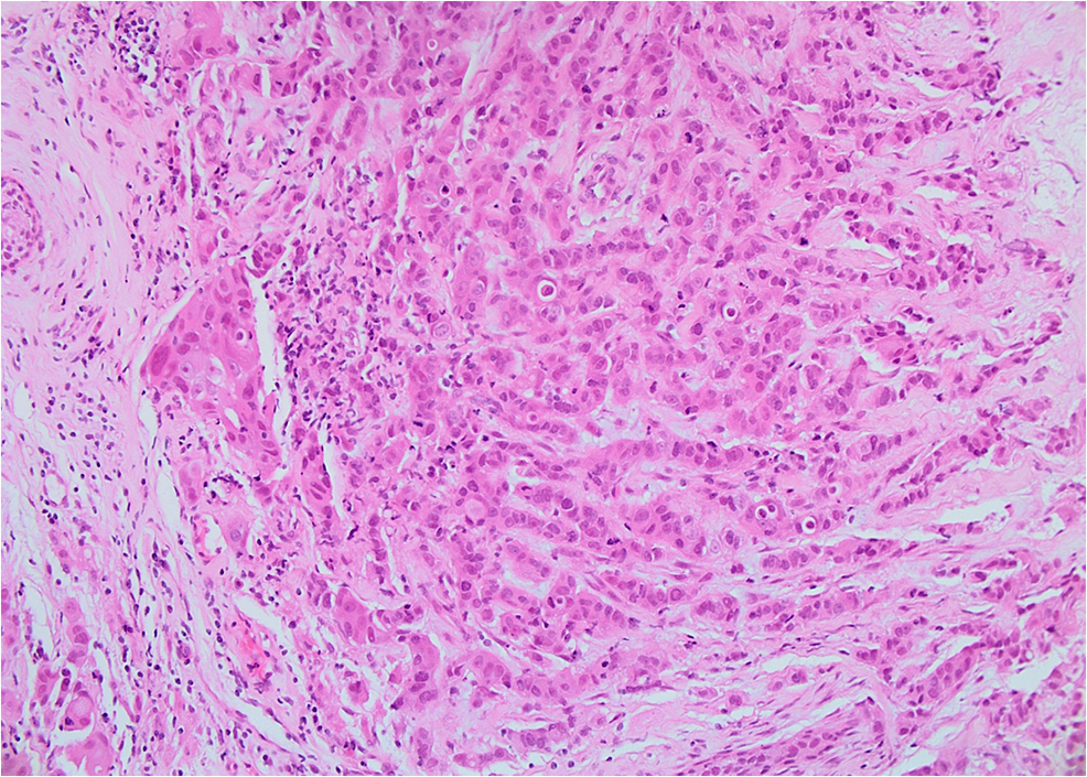 Cureus | Metastatic HER2+ Breast Cancer: A Potentially Curable Disease?