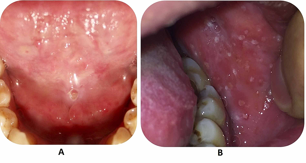 Cureus | Early Diagnosis of Stevens-Johnson Syndrome in the Dental ...