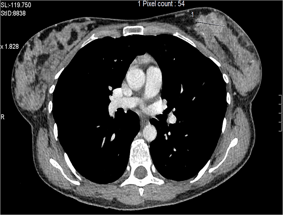 cureus-metastatic-her2-breast-cancer-a-potentially-curable-disease