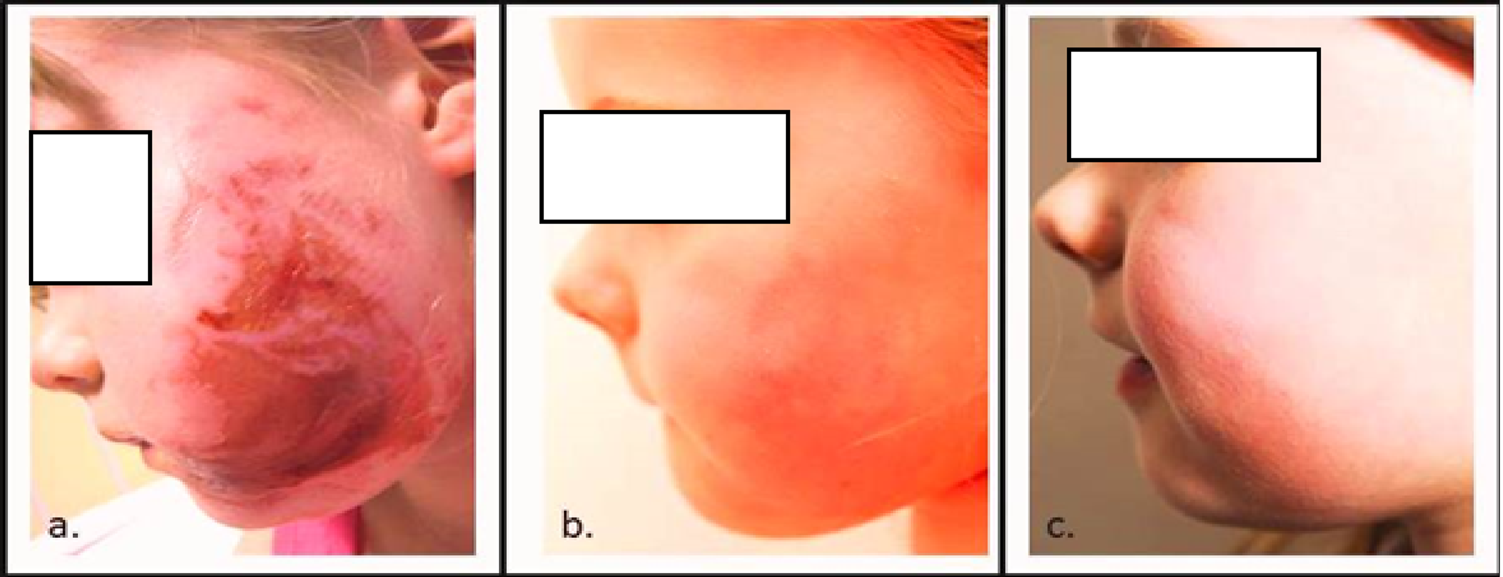 Cureus Paediatric Burns From Deployment of a Concealed Aviation