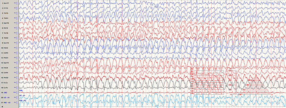 Cureus | Cefepime-Induced Encephalopathy With Seizures in a Pediatric ...