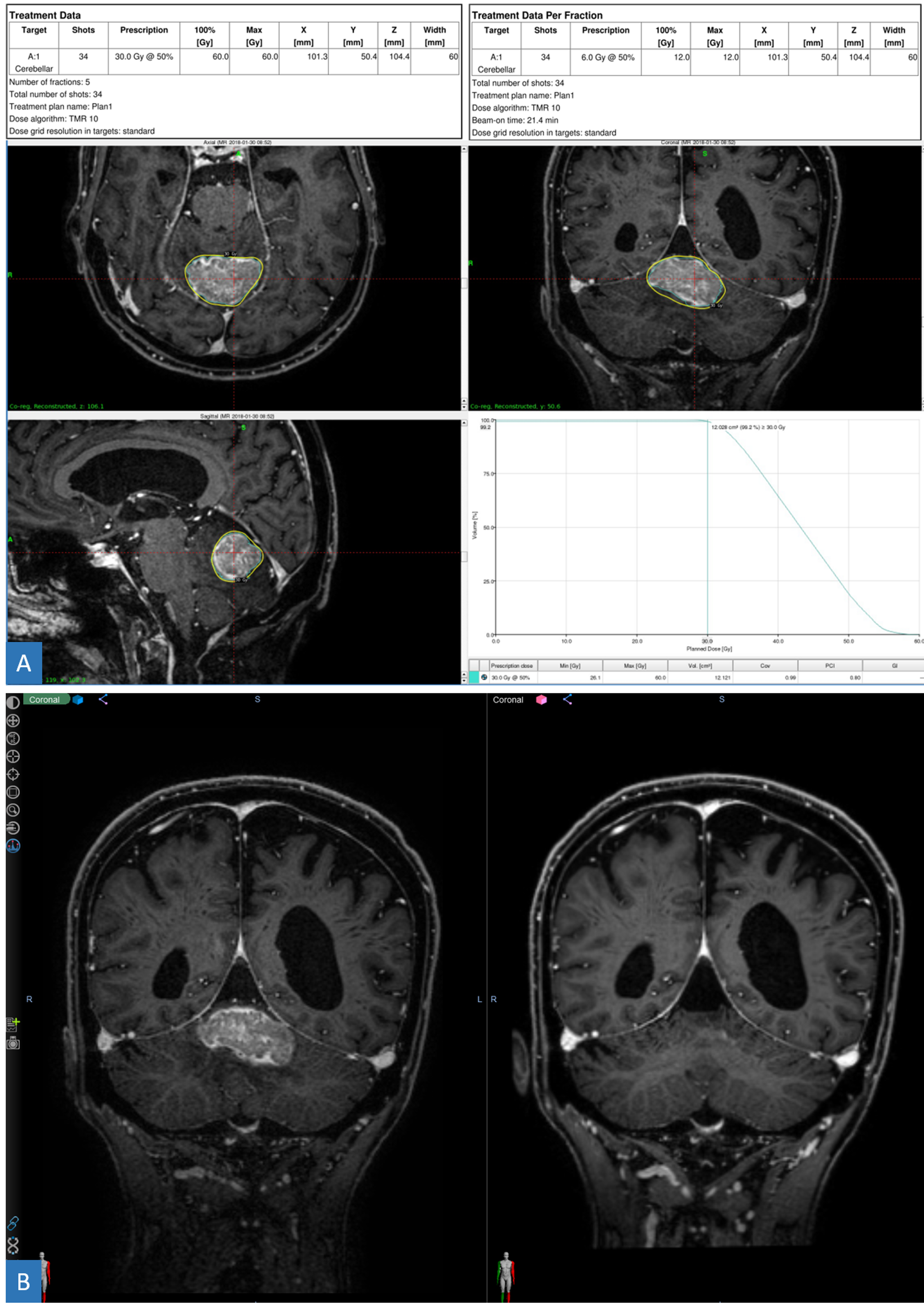 Cureus Expanded Radiosurgery Capabilities Utilizing Gamma Knife Icon