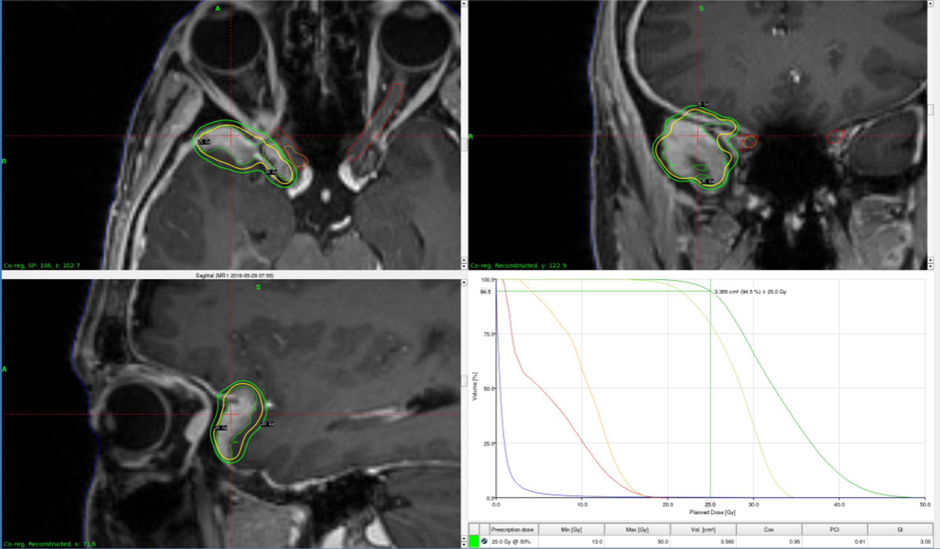 Cureus Expanded Radiosurgery Capabilities Utilizing Gamma Knife Icon