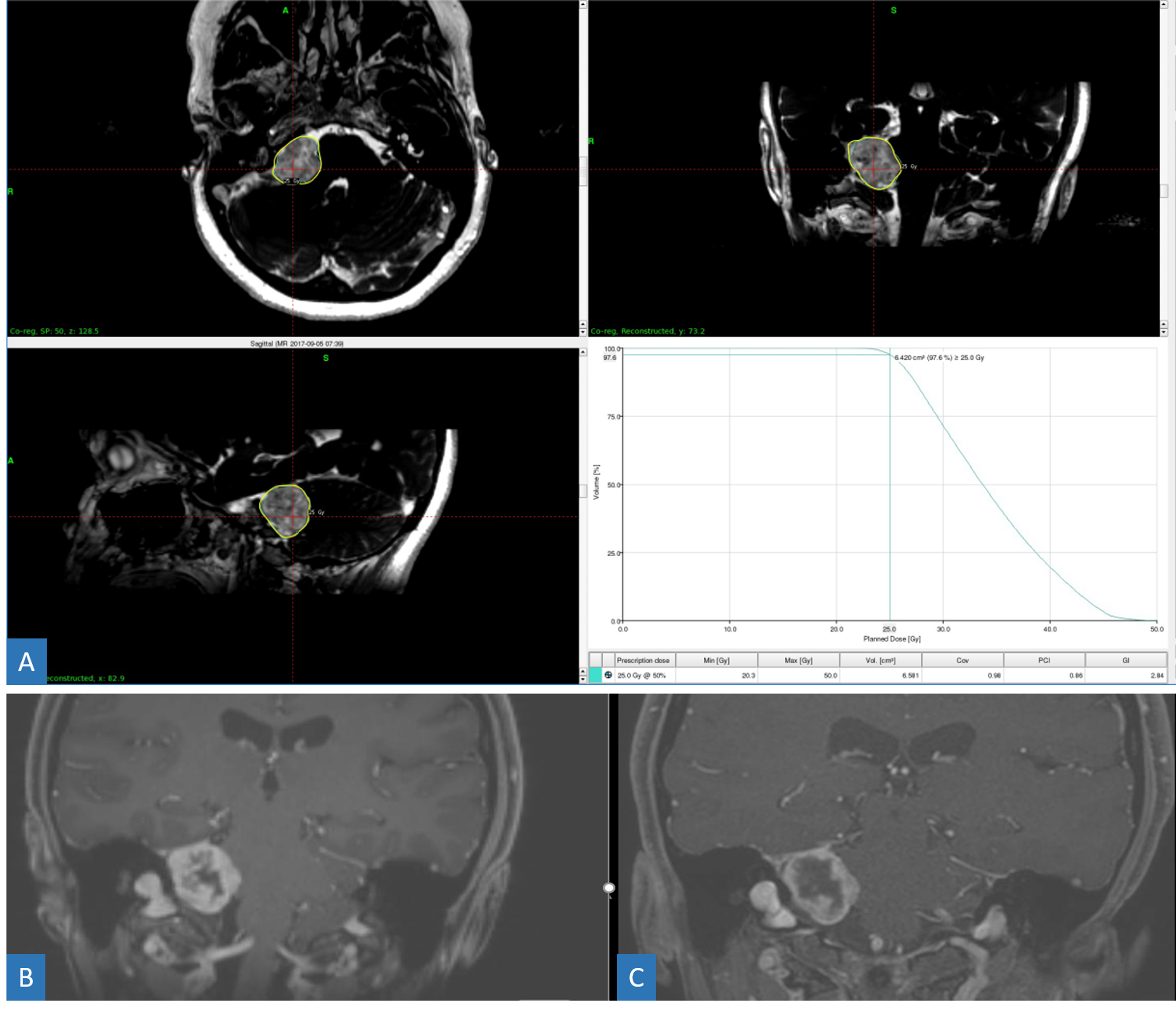 Cureus Expanded Radiosurgery Capabilities Utilizing Gamma Knife Icon