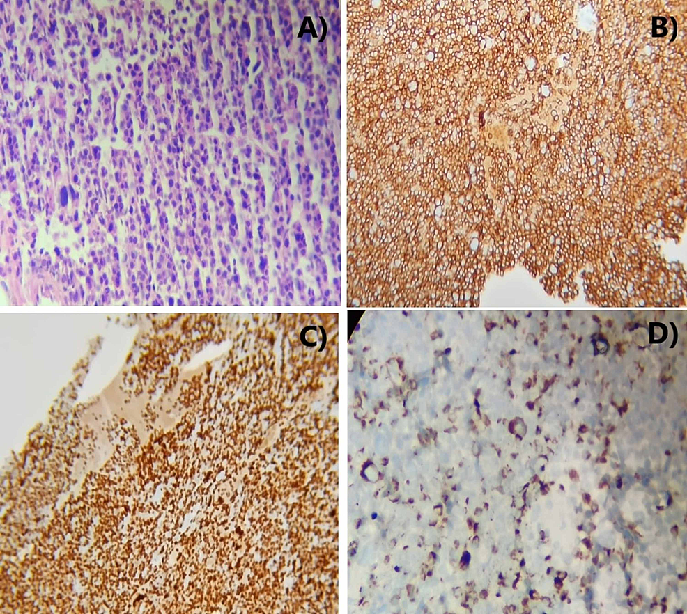 Cureus | Vanishing Bone As The Presenting Feature Of Multiple Myeloma