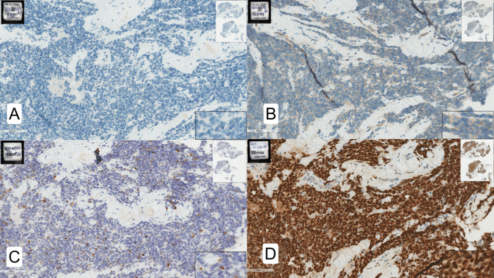 Anesthesia for Radiotherapy in Children With ASD: A Case Report