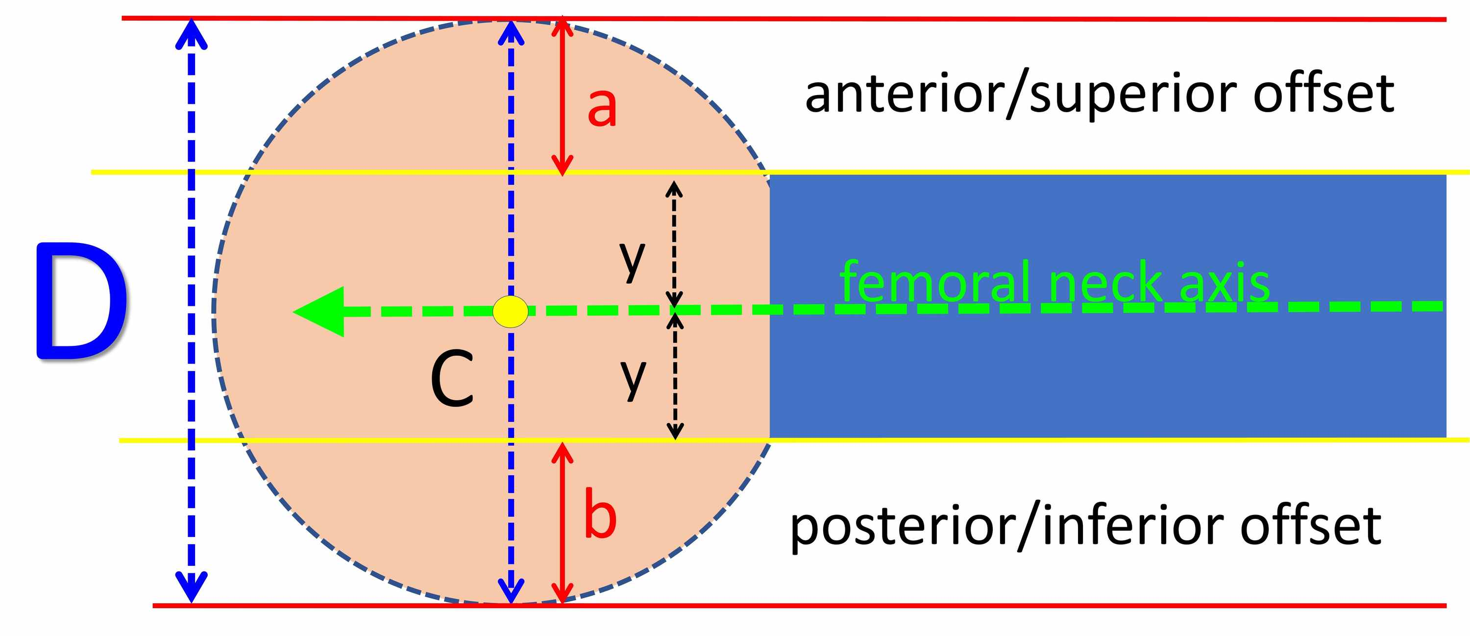 Cureus | Femoral Head-Neck Translation Ratio Is a Measurement of