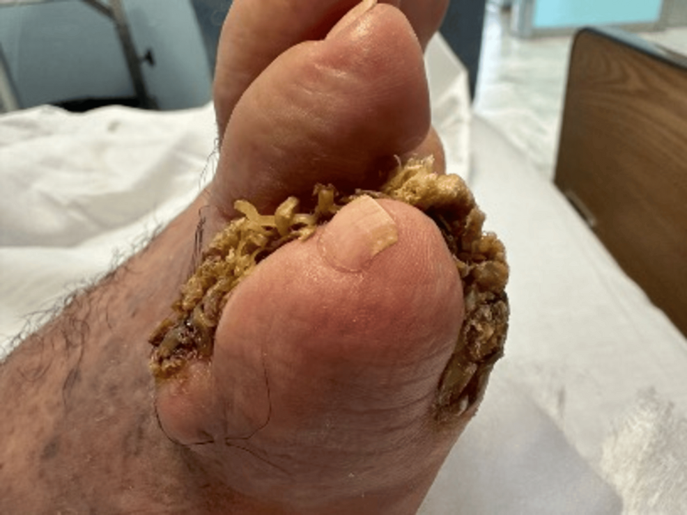 HPV Type 6 Linked to Interdigital Squamous Cell Carcinoma Mimicking Toe Infection