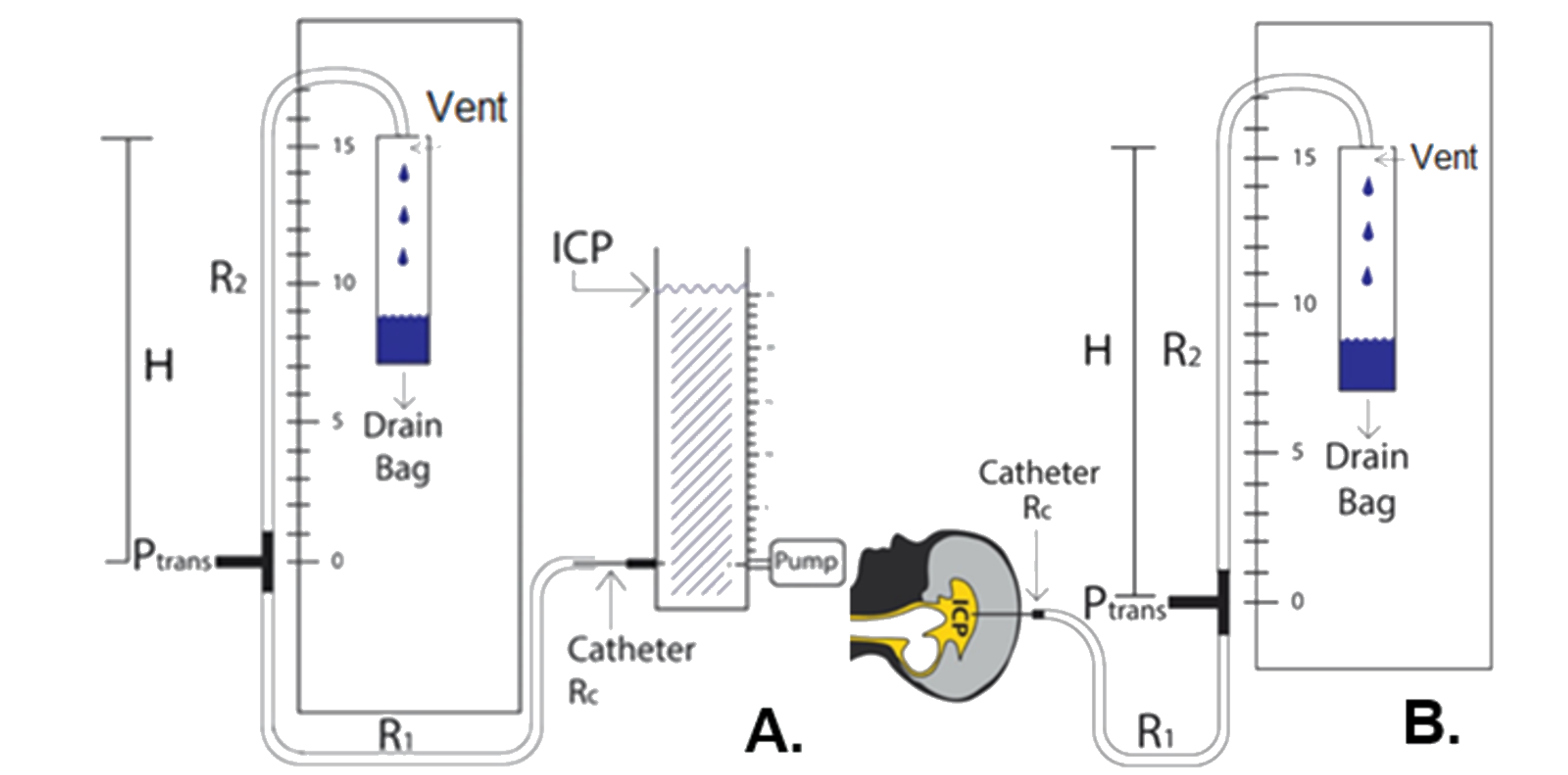 Cureus Fluidic Considerations Of Measuring Intracranial Pressure Using An Open External Ventricular Drain