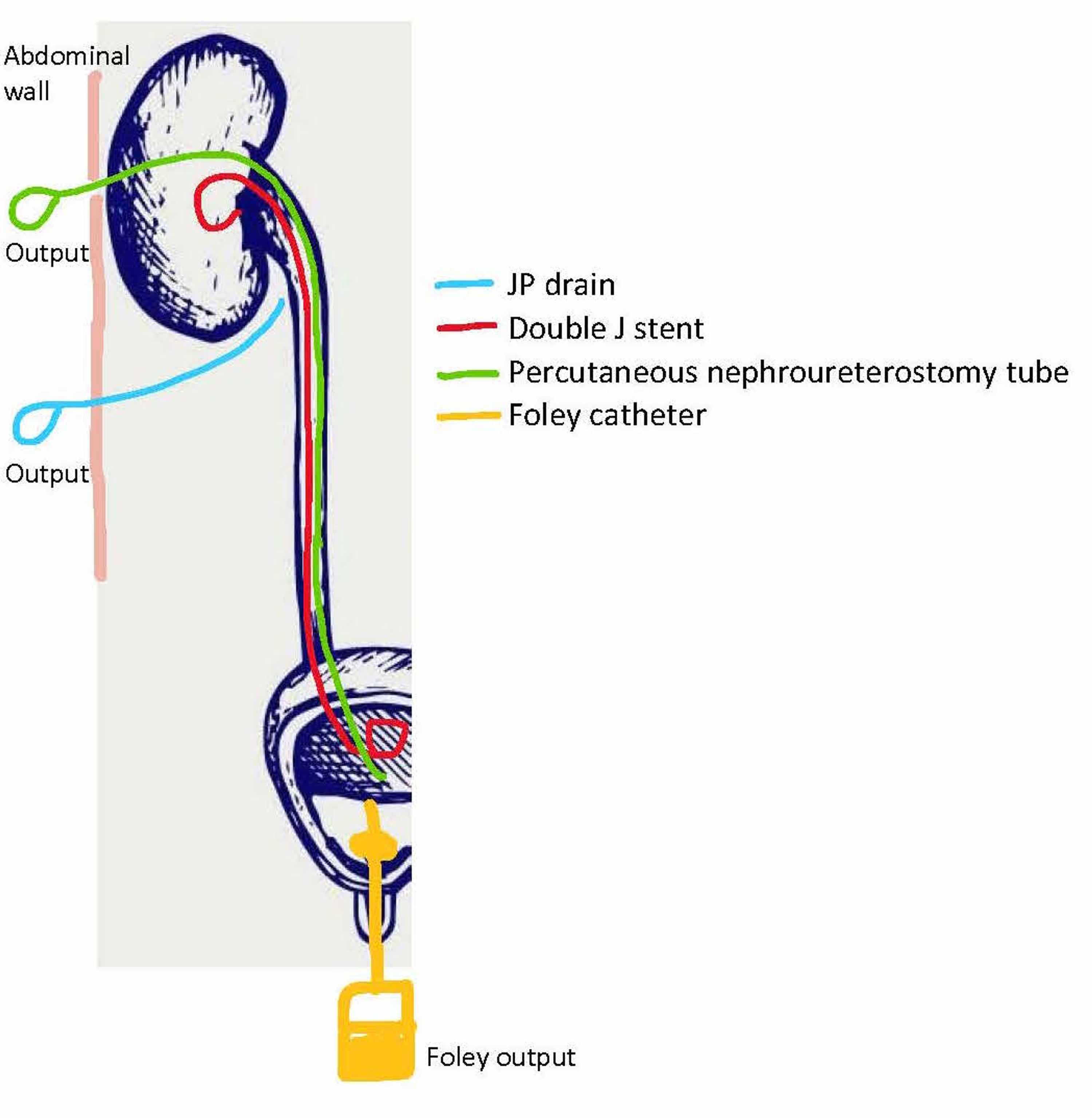 Urine Leak From the Necrotic Lower Pole of a Transplanted Kidney A