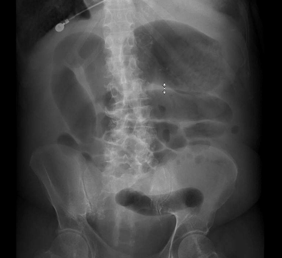 Cureus | Fulminant Pseudomembranous Colitis Leading to Clostridium ...