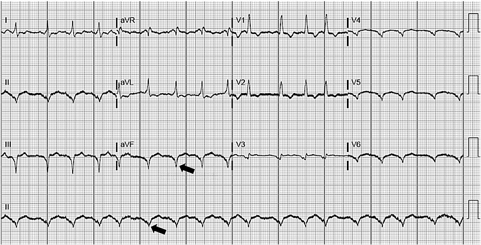 Cureus | Trauma Resuscitation in a Left Ventricular Assist Device ...