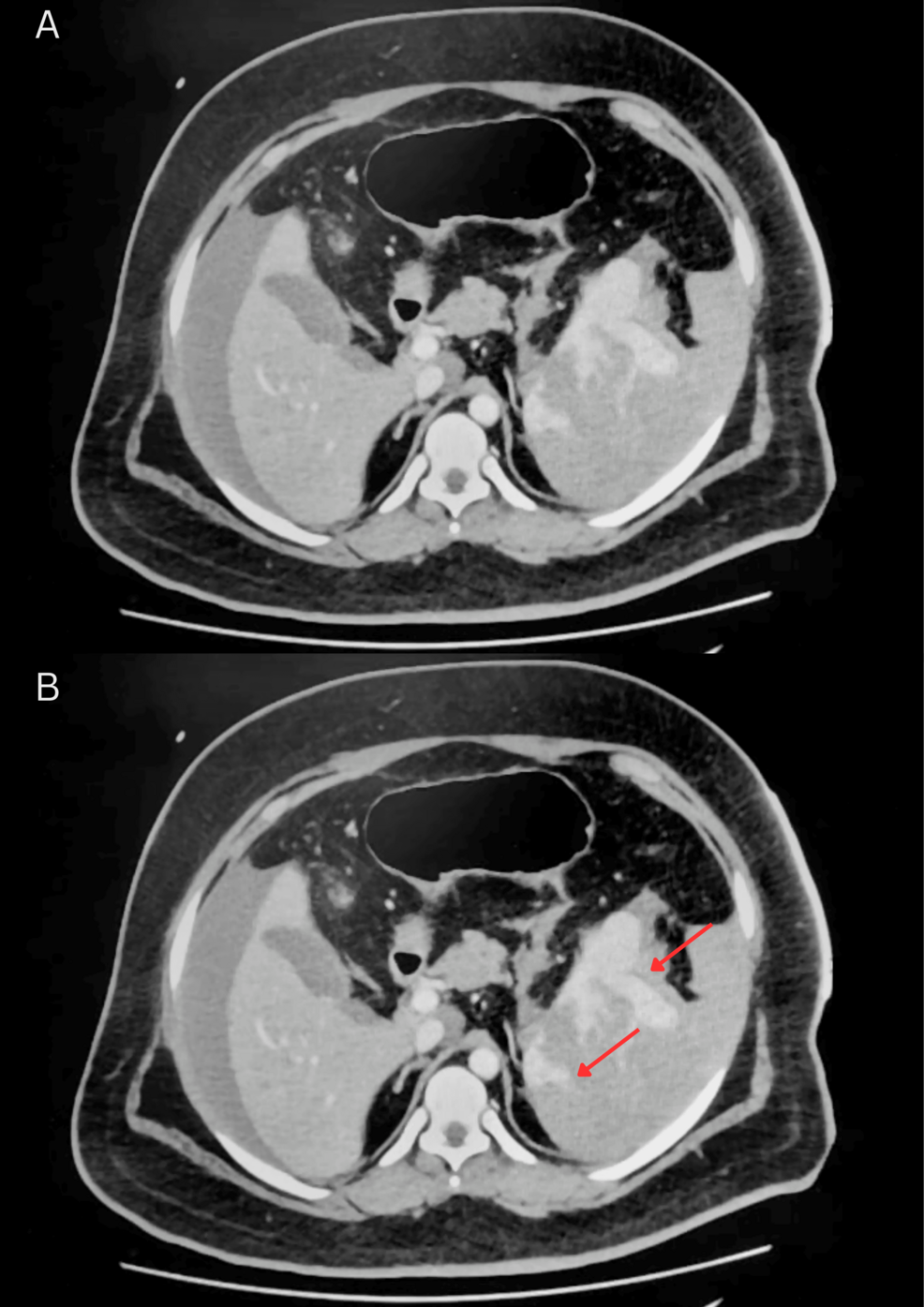 Splenic Rupture: Rare Case with Factor XIII & VII Deficiencies