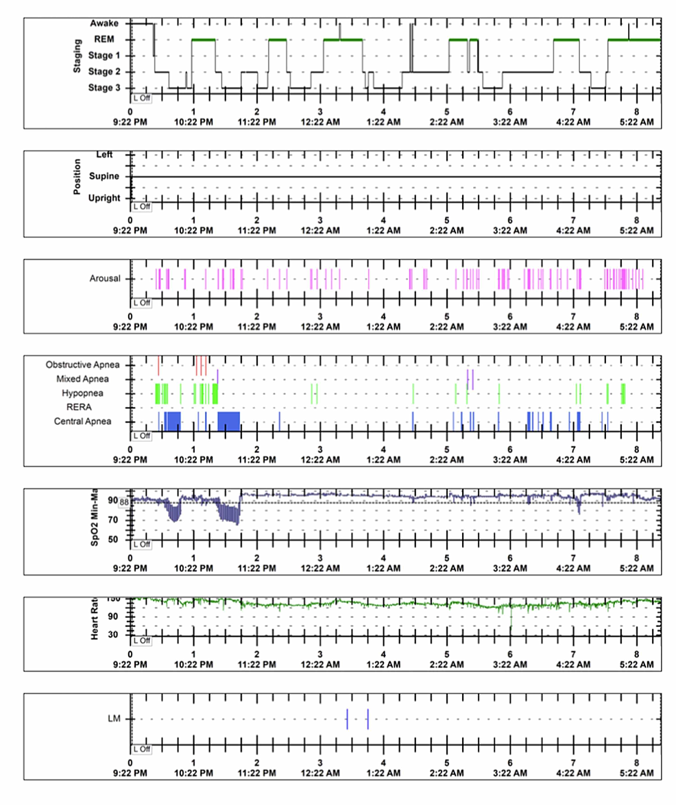 An Extremely Rare Case Of Birk-Barel Syndrome With Severe Central ...