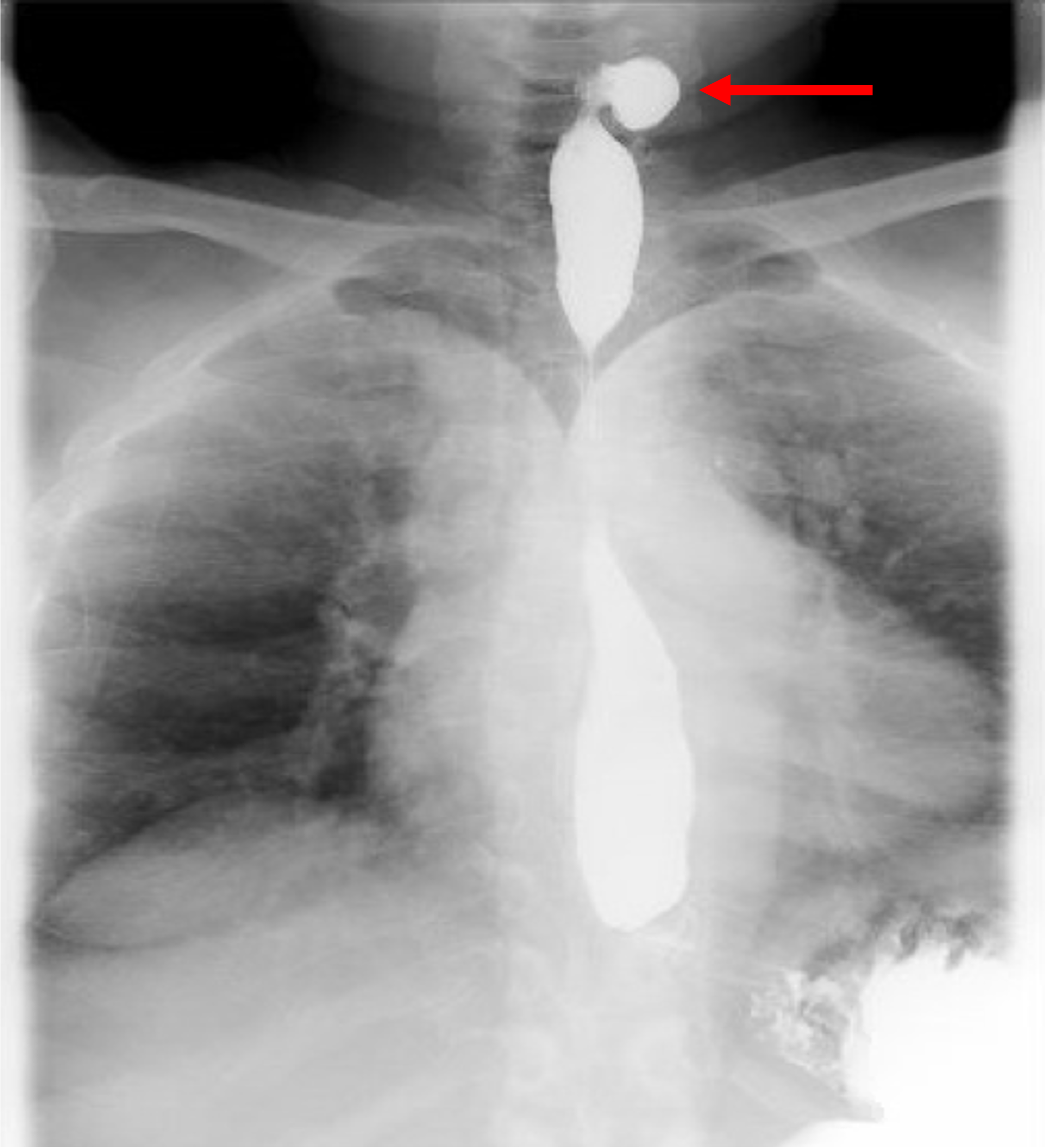 Cureus Killian Jamieson Diverticulum A Rare Cause Of Dysphagia
